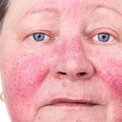 Rosacea